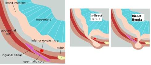 inguinal-canal-hernias